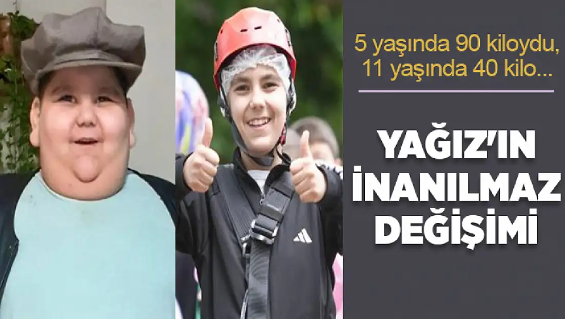 5 Yaşında 90 kiloydu, tedaviyle hayatı değişti