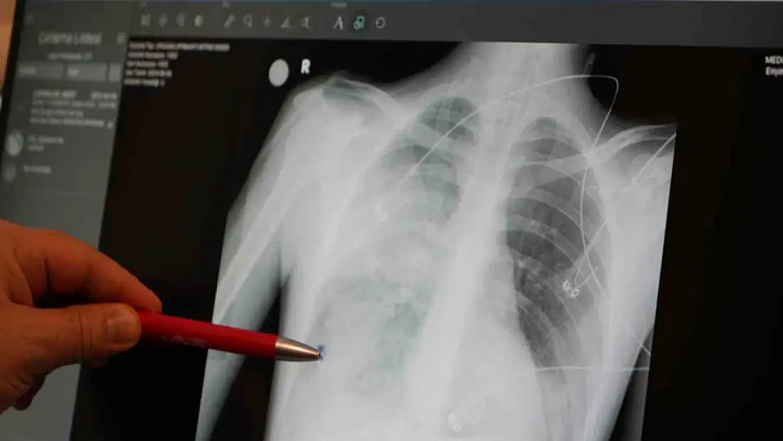 Zatürre önemli bir tehdit: Uzmandan Uyarılar