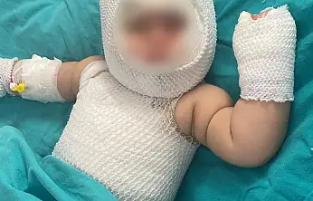 Konserve bomba gibi patladı vücudunda 3'üncü derece yanık oluştu