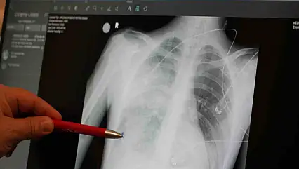 Zatürre önemli bir tehdit: Uzmandan Uyarılar