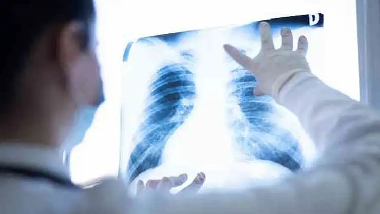 Akciğer kanserinde erken tanı başarı oranlarını artırıyor