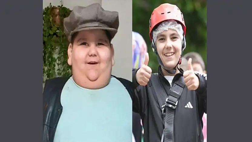 5 Yaşında 90 kiloydu, tedaviyle hayatı değişti