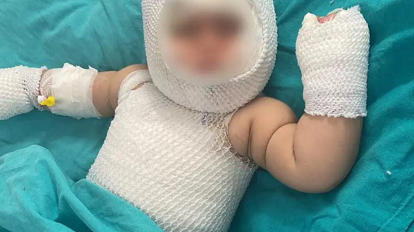 Konserve bomba gibi patladı vücudunda 3'üncü derece yanık oluştu