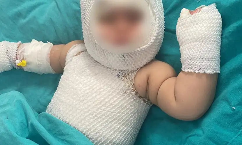 Konserve bomba gibi patladı vücudunda 3'üncü derece yanık oluştu